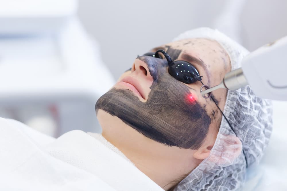 Carbon Face Peeling Procedure. Laser Pulses Clean Skin Of The Face. Hardware Cosmetology Treatment. Process Of Photothermolysis, Warming The Skin, Laser Carbon Peeling. Facial Skin Rejuvenation — Strut Hair & Beauty in Maroochydore, QLD